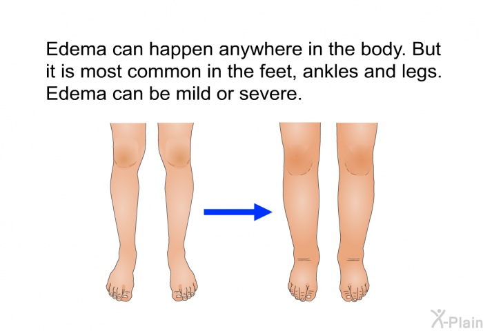Edema can happen anywhere in the body. But it is most common in the feet, ankles and legs. Edema can be mild or severe.