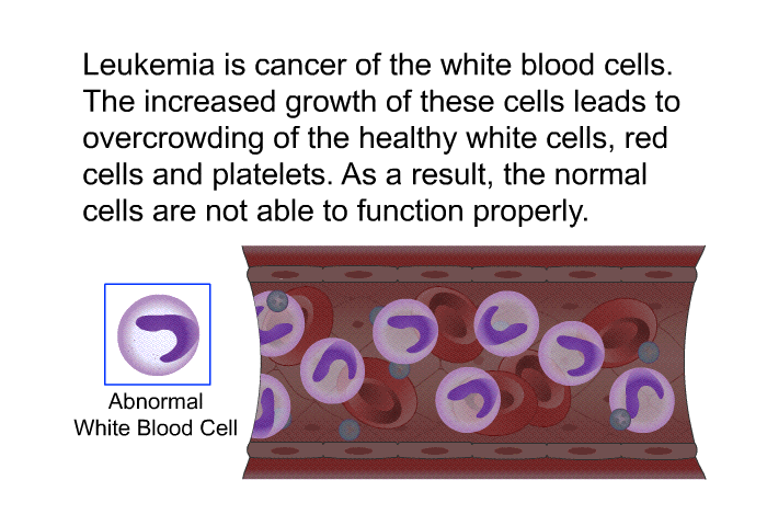 Leukemia is cancer of the white blood cells. The increased growth of these cells leads to overcrowding of the healthy white cells, red cells and platelets. As a result, the normal cells are not able to function properly.