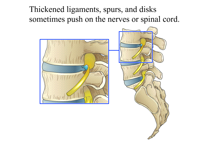 Thickened ligaments, spurs, and disks sometimes push on the nerves or spinal cord.