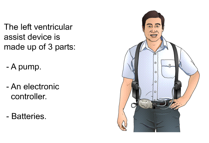 The left ventricular assist device is made up of 3 parts:  A pump. An electronic controller. Batteries.