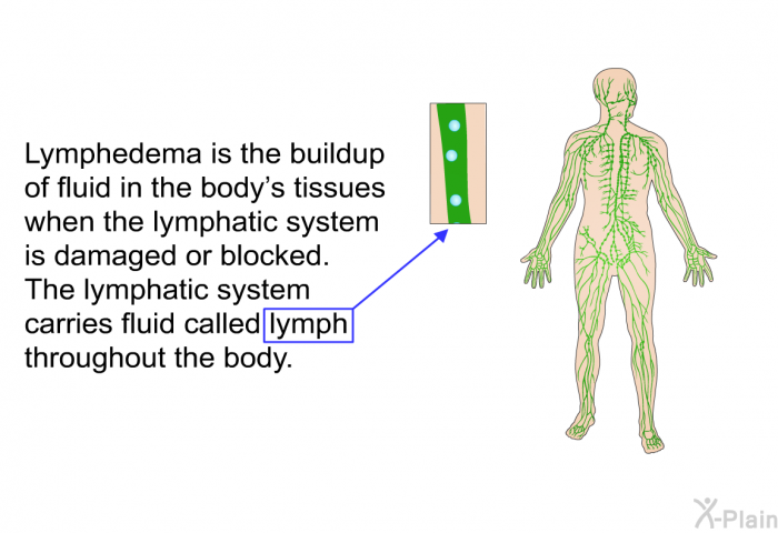 Lymphedema is the buildup of fluid in the body's tissues when the lymphatic system is damaged or blocked. The lymphatic system carries fluid called lymph throughout the body.