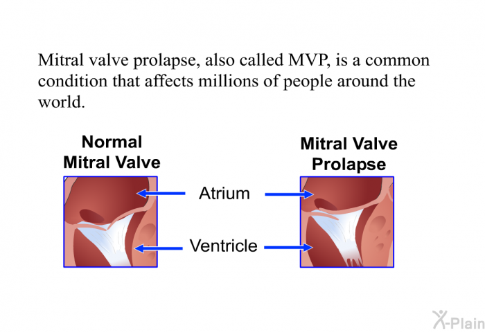 Mitral valve prolapse, also called MVP, is a common condition that affects millions of people around the world.