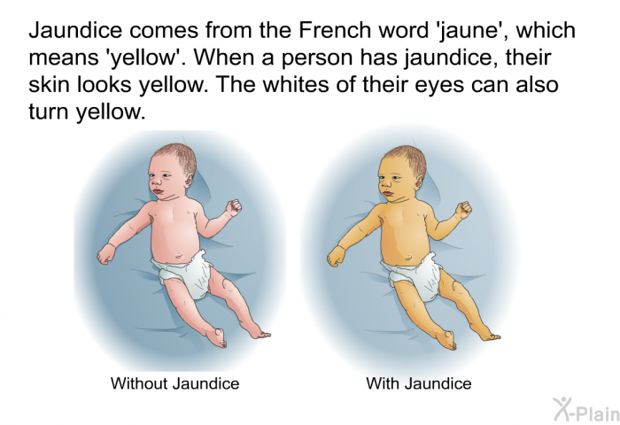Jaundice comes from the French word 'jaune', which means 'yellow'. When a person has jaundice, their skin looks yellow. The whites of their eyes can also turn yellow.