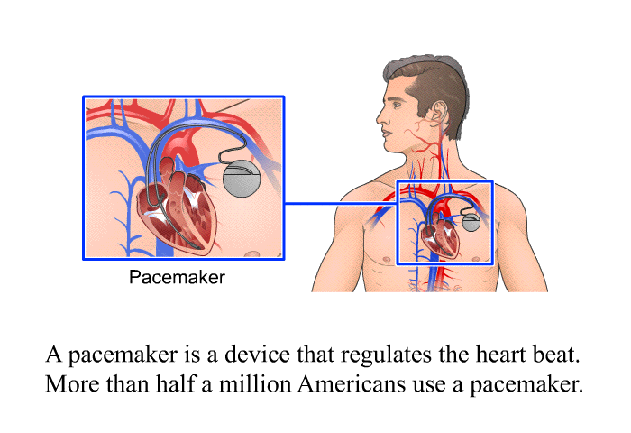 A pacemaker is a device that regulates the heart beat. More than half a million Americans use a pacemaker.