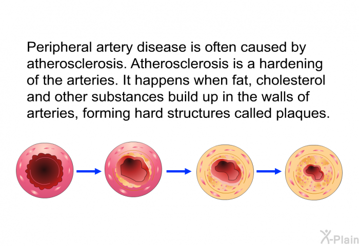 Peripheral artery disease is often caused by atherosclerosis. Atherosclerosis is a hardening of the arteries. It happens when fat, cholesterol and other substances build up in the walls of arteries, forming hard structures called plaques.