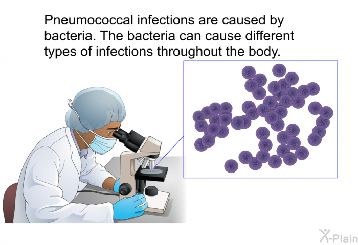 Pneumococcal infections are caused by bacteria. The bacteria can cause different types of infections throughout the body.