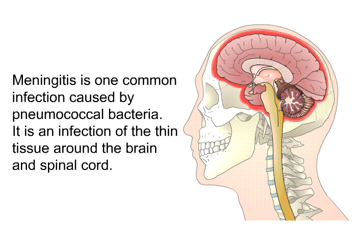 Meningitis is one common infection caused by pneumococcal bacteria. It is an infection of the thin tissue around the brain and spinal cord.