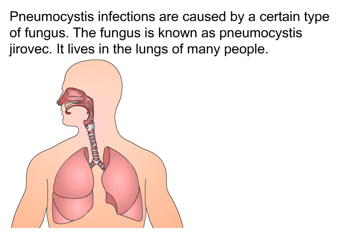 Pneumocystis infections are caused by a certain type of fungus. The fungus is known as pneumocystis jirovec. It lives in the lungs of many people.