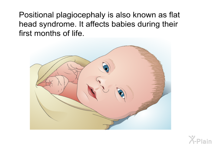 Positional plagiocephaly is also known as flat head syndrome. It affects babies during their first months of life.