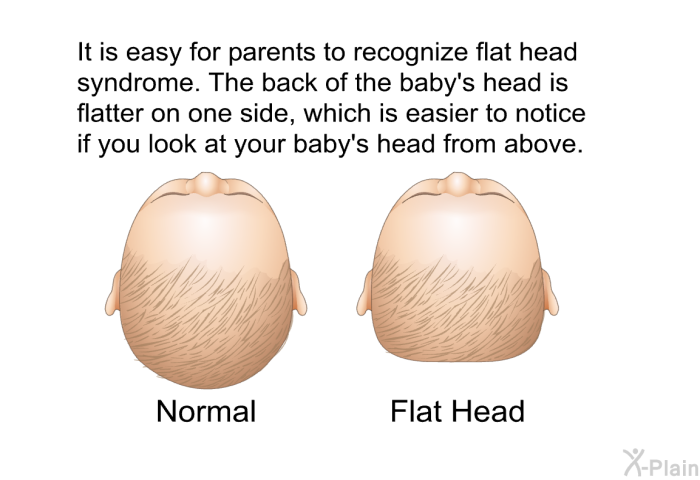 It is easy for parents to recognize flat head syndrome. The back of the baby's head is flatter on one side, which is easier to notice if you look at your baby's head from above.