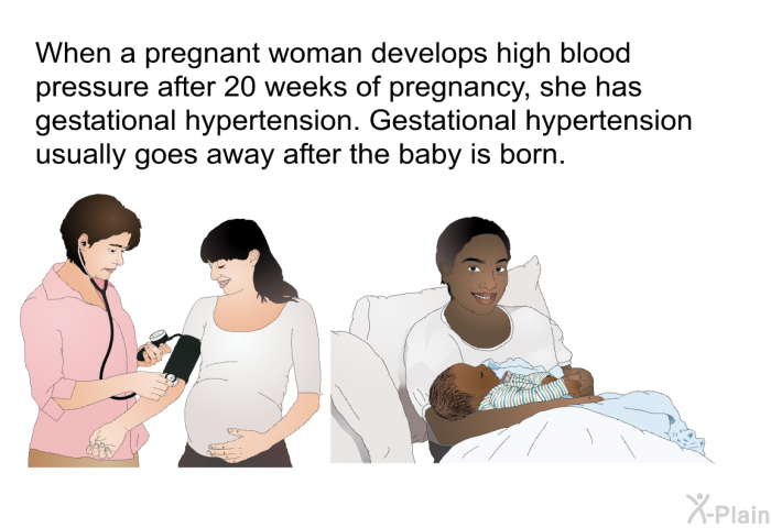 When a pregnant woman develops high blood pressure after 20 weeks of pregnancy, she has gestational hypertension. Gestational hypertension usually goes away after the baby is born.