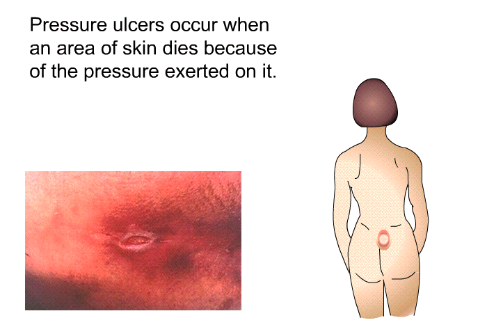 Pressure ulcers occur when an area of skin dies because of the pressure exerted on it.
