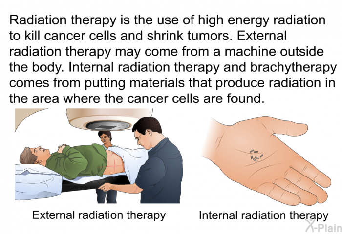 Radiation therapy is the use of high energy radiation to kill cancer cells and shrink tumors. External radiation therapy may come from a machine outside the body. Internal radiation therapy and brachytherapy comes from putting materials that produce radiation in the area where the cancer cells are found.