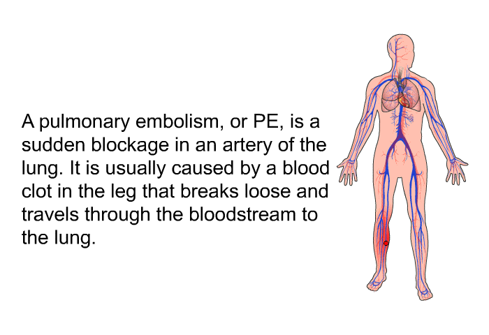 A pulmonary embolism, or PE, is a sudden blockage in an artery of the lung. It is usually caused by a blood clot in the leg that breaks loose and travels through the bloodstream to the lung.