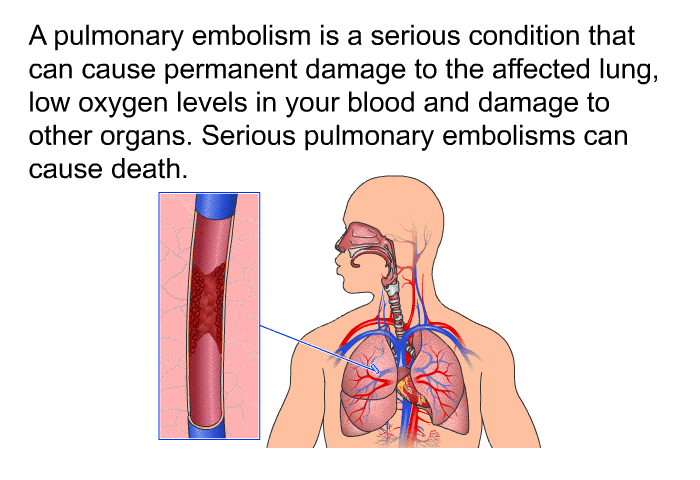 A pulmonary embolism is a serious condition that can cause permanent damage to the affected lung, low oxygen levels in your blood and damage to other organs. Serious pulmonary embolisms can cause death.