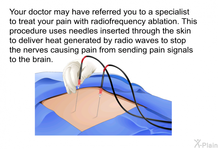 Your doctor may have referred you to a specialist to treat your pain with radiofrequency ablation. This procedure uses needles inserted through the skin to deliver heat generated by radio waves to stop the nerves causing pain from sending pain signals to the brain.