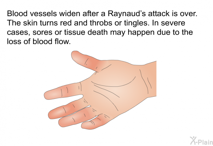 Blood vessels widen after a Raynaud's attack is over. The skin turns red and throbs or tingles. In severe cases, sores or tissue death may happen due to the loss of blood flow.