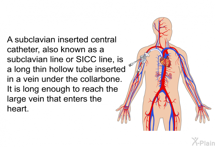 A subclavian inserted central catheter, also known as a subclavian line or SICC line, is a long thin hollow tube inserted in a vein under the collarbone. It is long enough to reach the large vein that enters the heart.