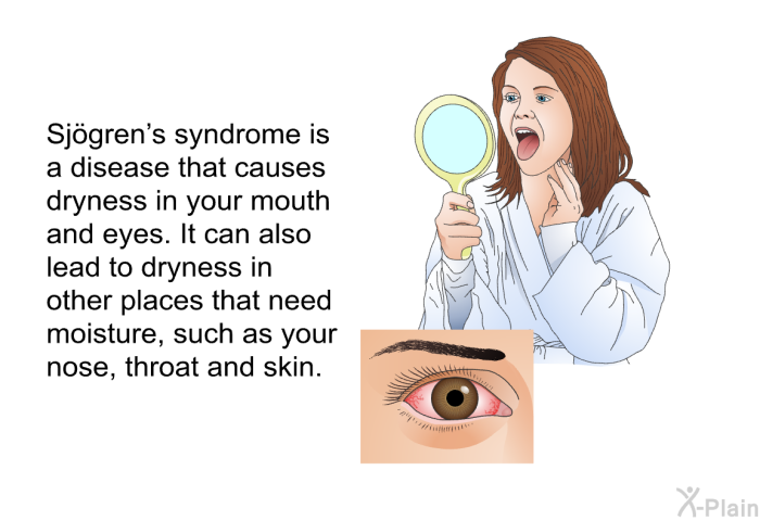 Sjögren's syndrome is a disease that causes dryness in your mouth and eyes. It can also lead to dryness in other places that need moisture, such as your nose, throat and skin.