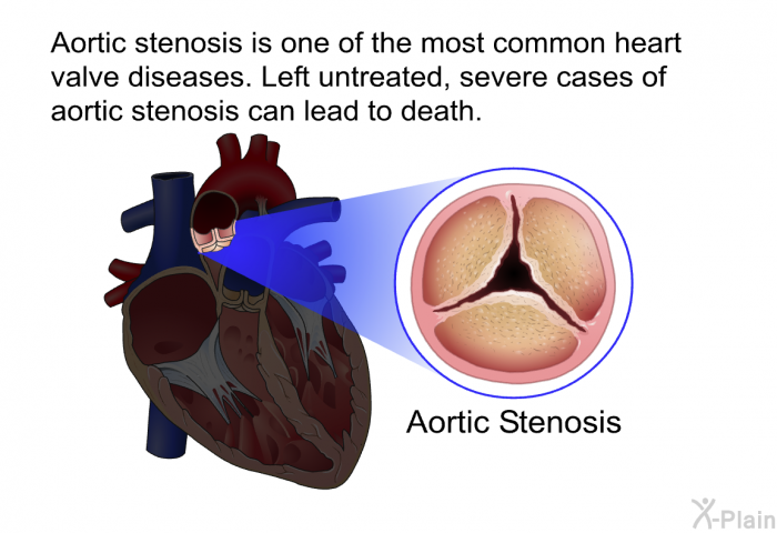Aortic stenosis is one of the most common heart valve diseases. Left untreated, severe cases of aortic stenosis can lead to death.