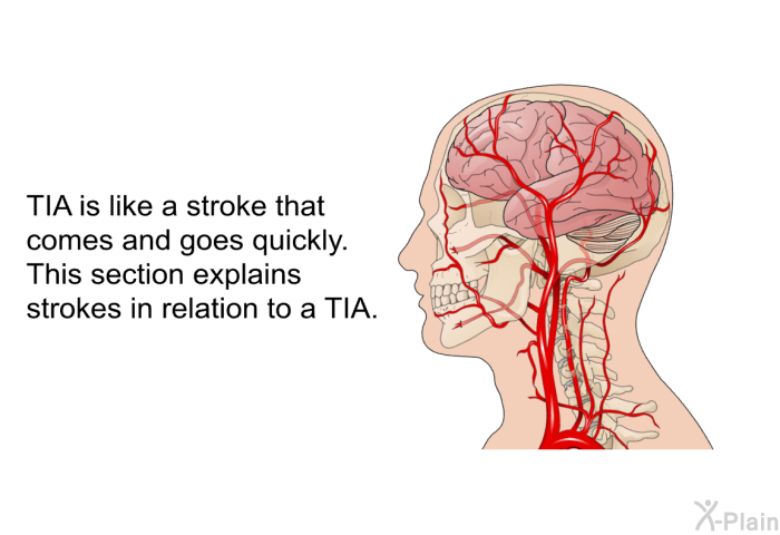 TIA is like a stroke that comes and goes quickly. This section explains strokes in relation to a TIA.