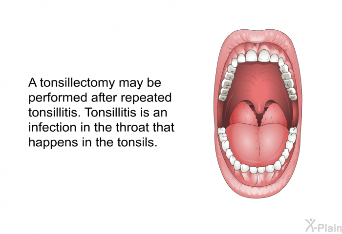 A tonsillectomy may be performed after repeated tonsillitis. Tonsillitis is an infection in the throat that happens in the tonsils.