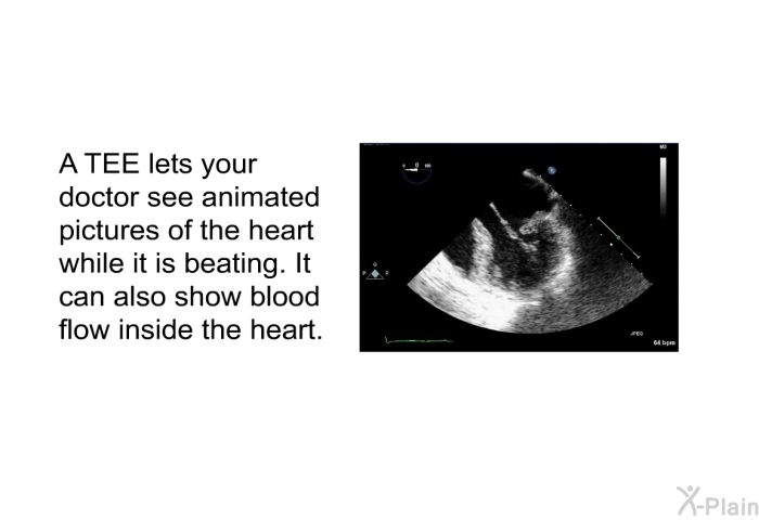 A TEE lets your doctor see animated pictures of the heart while it is beating. It can also show blood flow inside the heart.