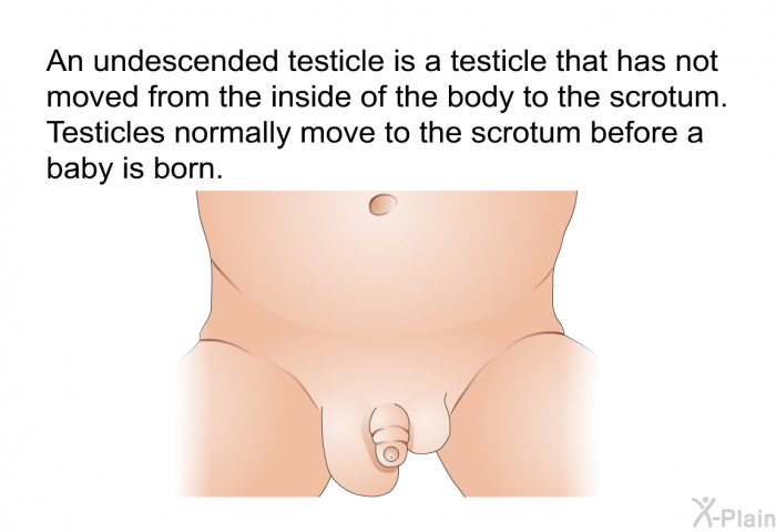 An undescended testicle is a testicle that has not moved from the inside of the body to the scrotum. Testicles normally move to the scrotum before a baby is born.