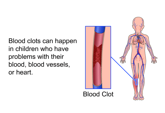 Blood clots can happen in children who have problems with their blood, blood vessels, or heart.