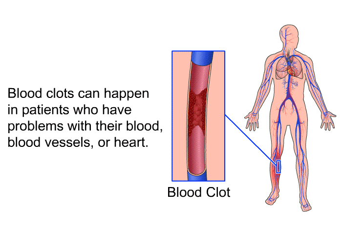 Blood clots can happen in patients who have problems with their blood, blood vessels, or heart.