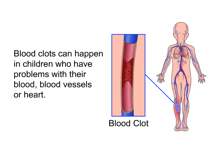 Blood clots can happen in children who have problems with their blood, blood vessels or heart.