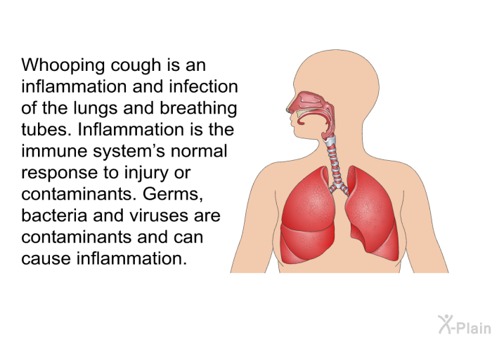 Whooping cough is an inflammation and infection of the lungs and breathing tubes. Inflammation is the immune system's normal response to injury or contaminants. Germs, bacteria and viruses are contaminants and can cause inflammation.