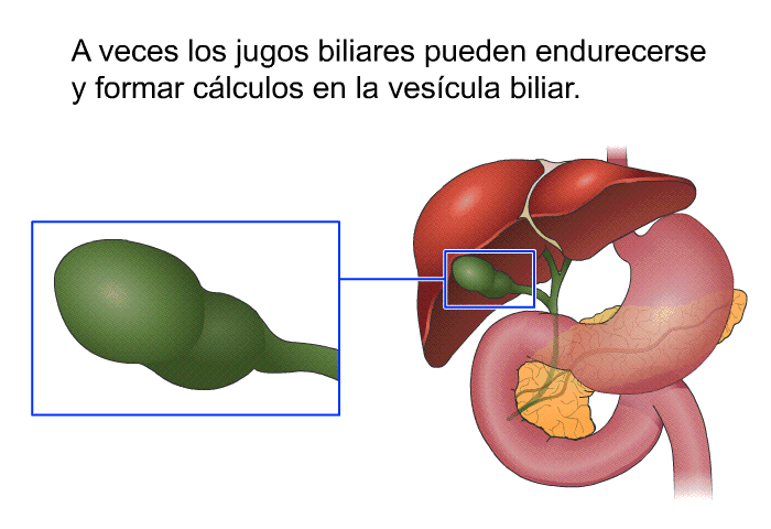 A veces los jugos biliares pueden endurecerse y formar clculos en la vescula biliar.