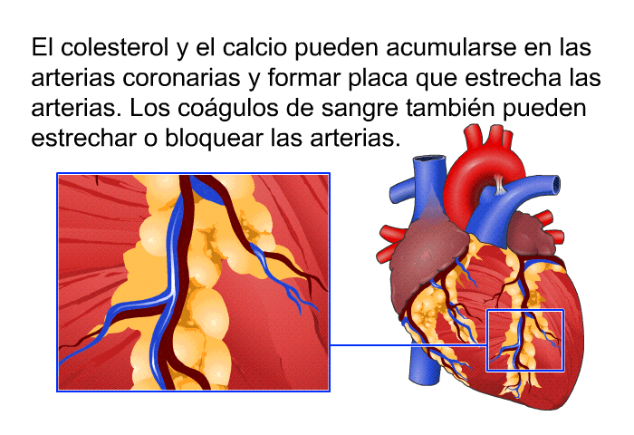 El colesterol y el calcio pueden acumularse en las arterias coronarias y formar placa que estrecha las arterias. Los cogulos de sangre tambin pueden estrechar o bloquear las arterias.
