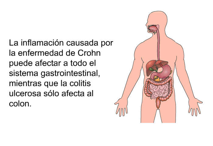 La inflamacin causada por la enfermedad de Crohn puede afectar a todo el sistema gastrointestinal, mientras que la colitis ulcerosa slo afecta al colon.