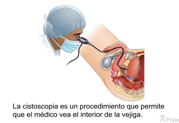 La cistoscopia es un procedimiento que permite que el mdico vea el interior de la vejiga.