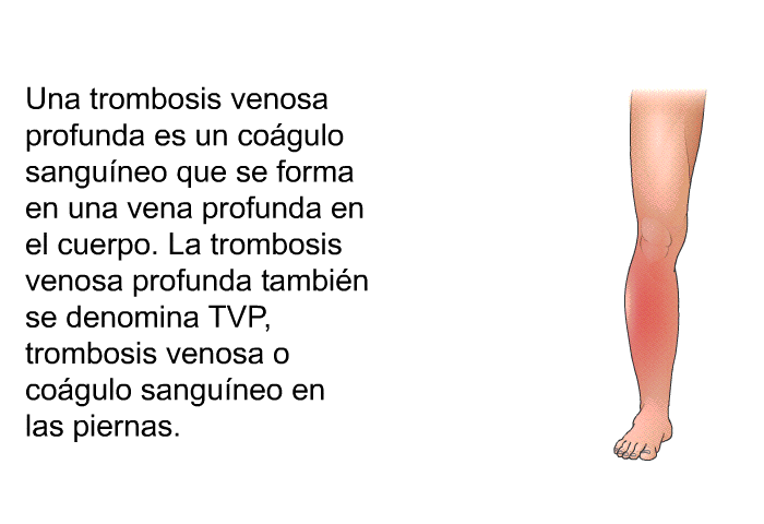 Una trombosis venosa profunda es un cogulo sanguneo que se forma en una vena profunda en el cuerpo. La trombosis venosa profunda tambin se denomina TVP, trombosis venosa o cogulo sanguneo en las piernas.