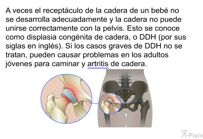 A veces el recept?culo de la cadera de un beb? no se desarrolla adecuadamente y la cadera no puede unirse correctamente con la pelvis. Esto se conoce como displasia cong?nita de cadera, o DDH (por sus siglas en ingl?s). Si los casos graves de DDH no se tratan, pueden causar problemas en los adultos j?venes para caminar y artritis de cadera.