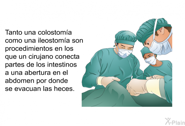 Tanto una colostoma como una ileostoma son procedimientos en los que un cirujano conecta partes de los intestinos a una abertura en el abdomen por donde se evacuan las heces.