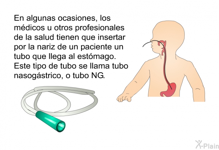 En algunas ocasiones, los mdicos u otros profesionales de la salud tienen que insertar por la nariz de un paciente un tubo que llega al estmago. Este tipo de tubo se llama tubo nasogstrico, o tubo NG.