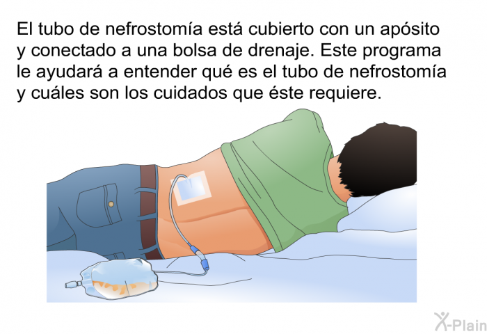 El tubo de nefrostoma est cubierto con un apsito y conectado a una bolsa de drenaje. Esta informacin acerca de su salud le ayudar a entender qu es el tubo de nefrostoma y cules son los cuidados que ste requiere.