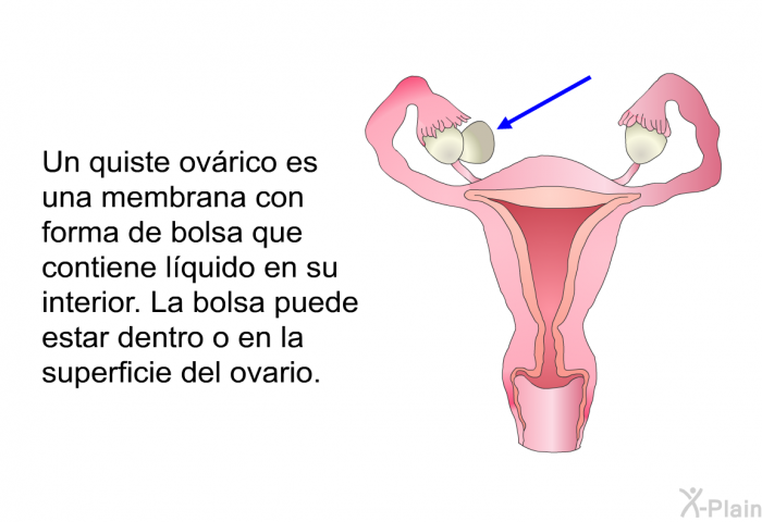 Un quiste ovrico es una membrana con forma de bolsa que contiene lquido en su interior. La bolsa puede estar dentro o en la superficie del ovario. 