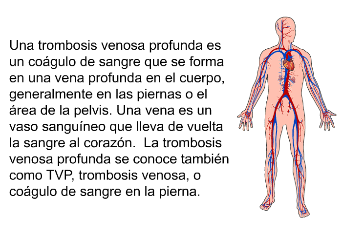 Una trombosis venosa profunda es un cogulo de sangre que se forma en una vena profunda en el cuerpo, generalmente en las piernas o el rea de la pelvis. Una vena es un vaso sanguneo que lleva de vuelta la sangre al corazn. La trombosis venosa profunda se conoce tambin como TVP, trombosis venosa, o cogulo de sangre en la pierna.