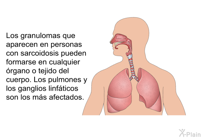 Los granulomas que aparecen en personas con sarcoidosis pueden formarse en cualquier rgano o tejido del cuerpo. Los pulmones y los ganglios linfticos son los ms afectados.