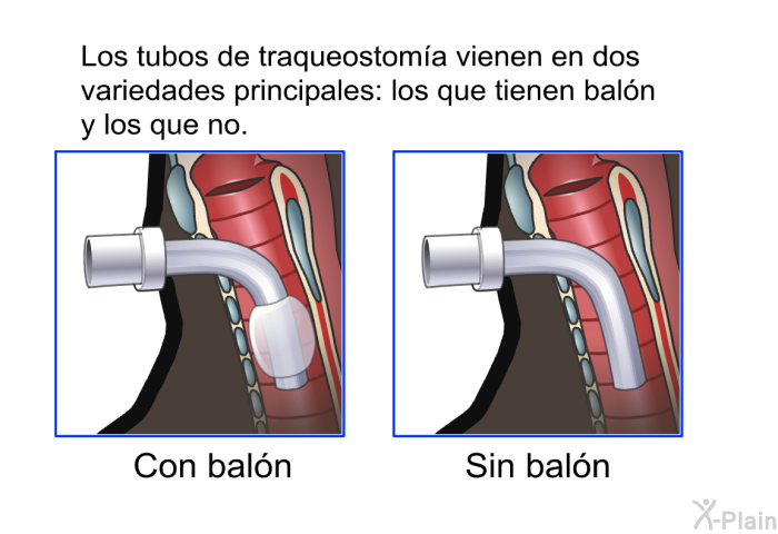 Los tubos de traqueostoma vienen en dos variedades principales: los que tienen baln y los que no.