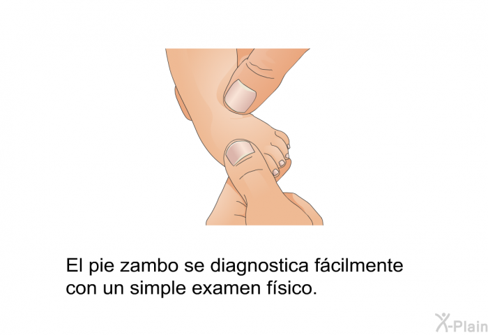 El pie zambo se diagnostica fcilmente con un simple examen fsico.