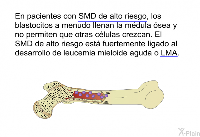 En pacientes con SMD de alto riesgo, los blastocitos a menudo llenan la mdula sea y no permiten que otras clulas crezcan. El SMD de alto riesgo est fuertemente ligado al desarrollo de leucemia mieloide aguda o LMA.